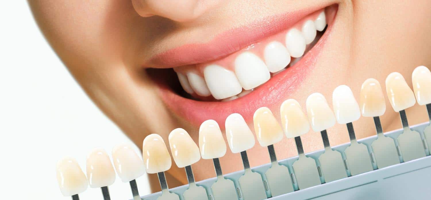 What Causes Yellow Teeth__and_How_to_Avoid_It