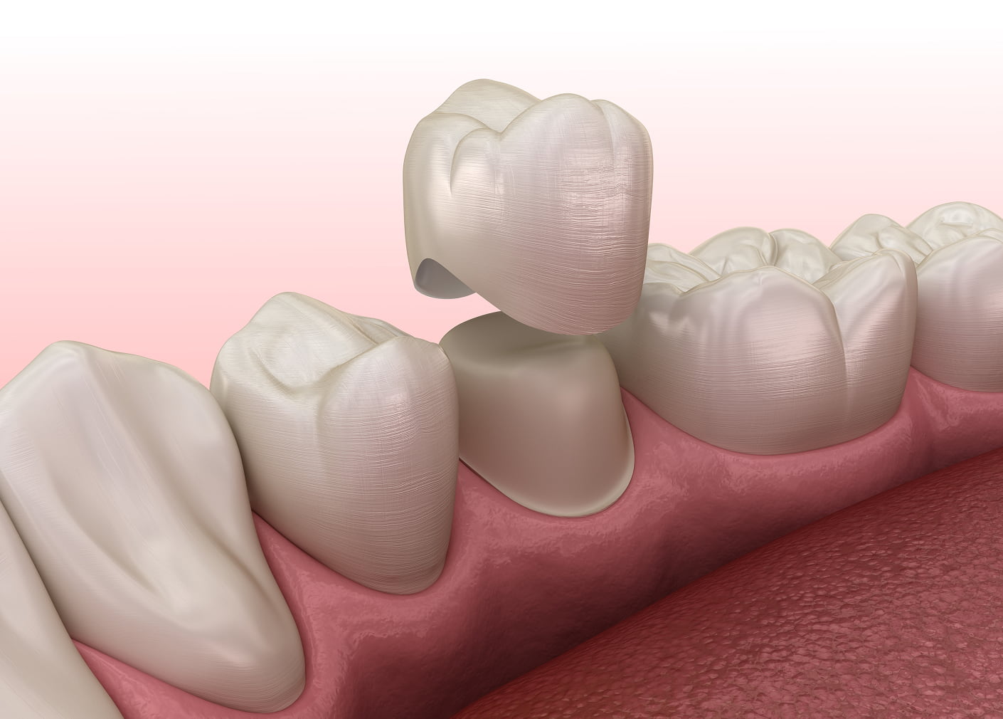Crowns restore damaged teeth and support dental bridges