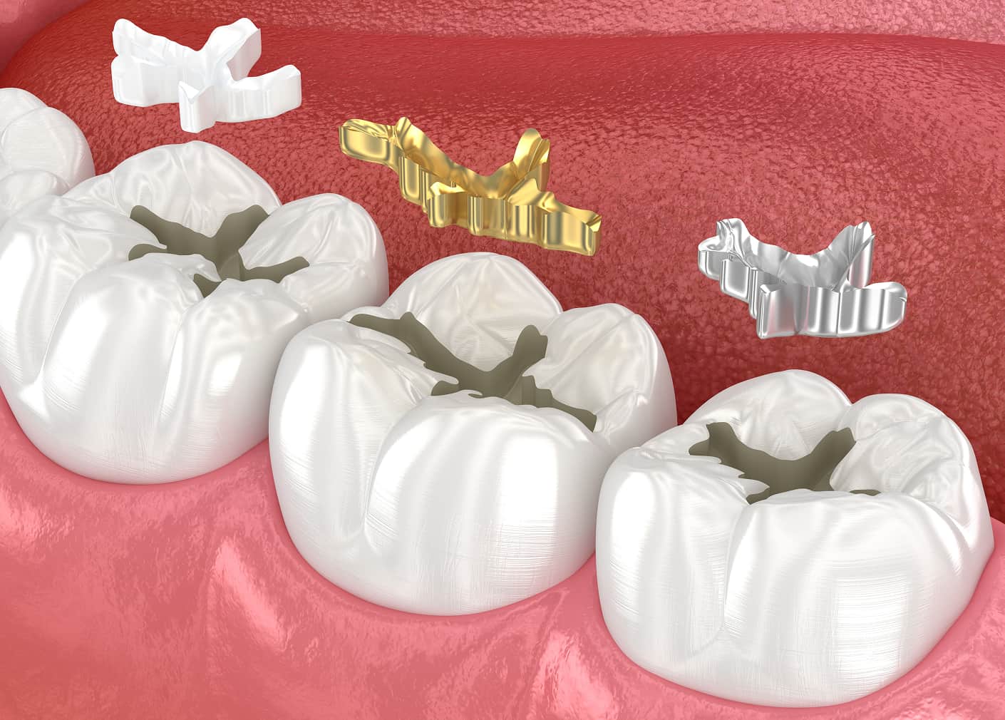 Fillings treat cavities, chipped teeth, and worn-down areas