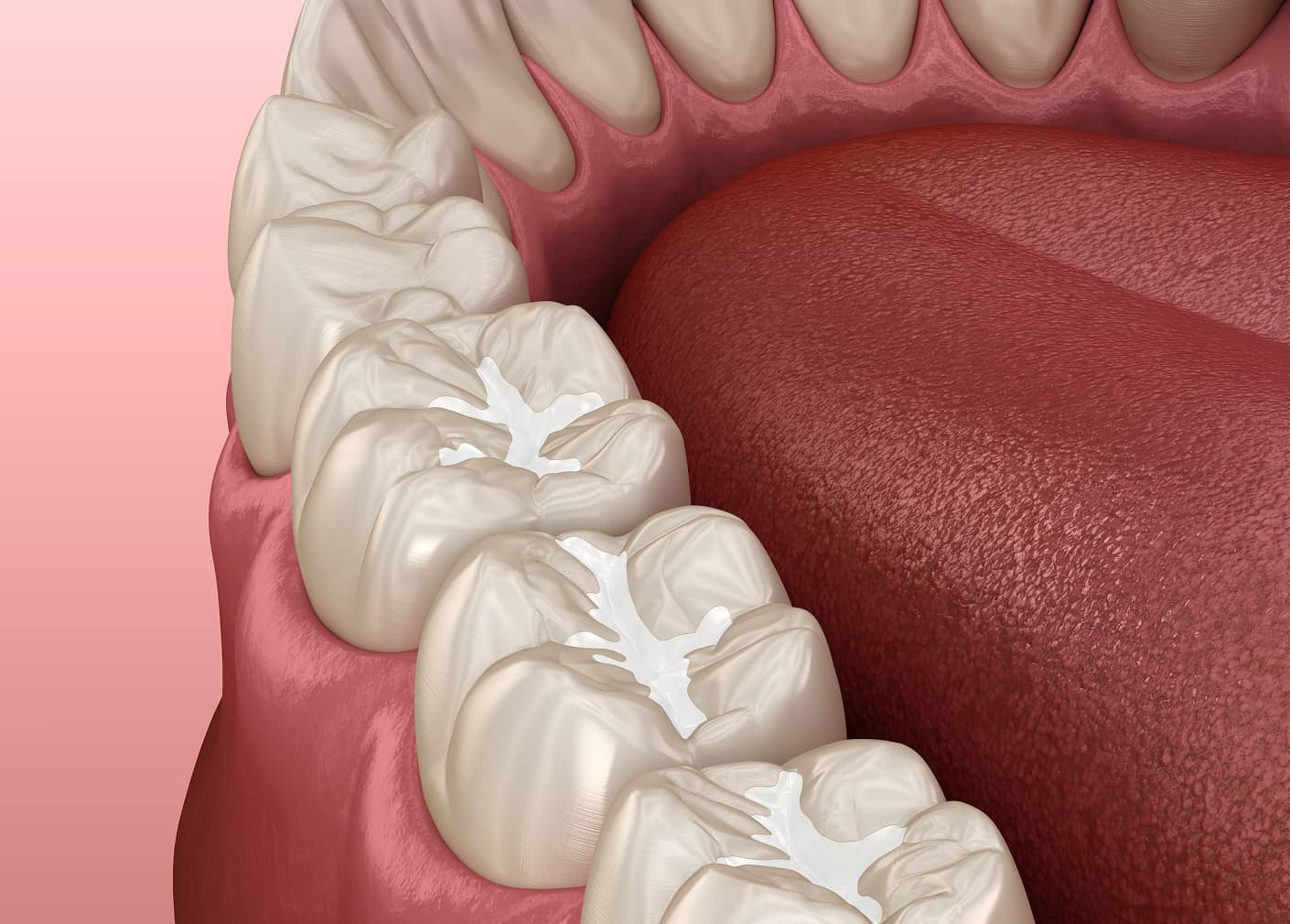 Sealants protect teeth from cavities and decay for kids and adults