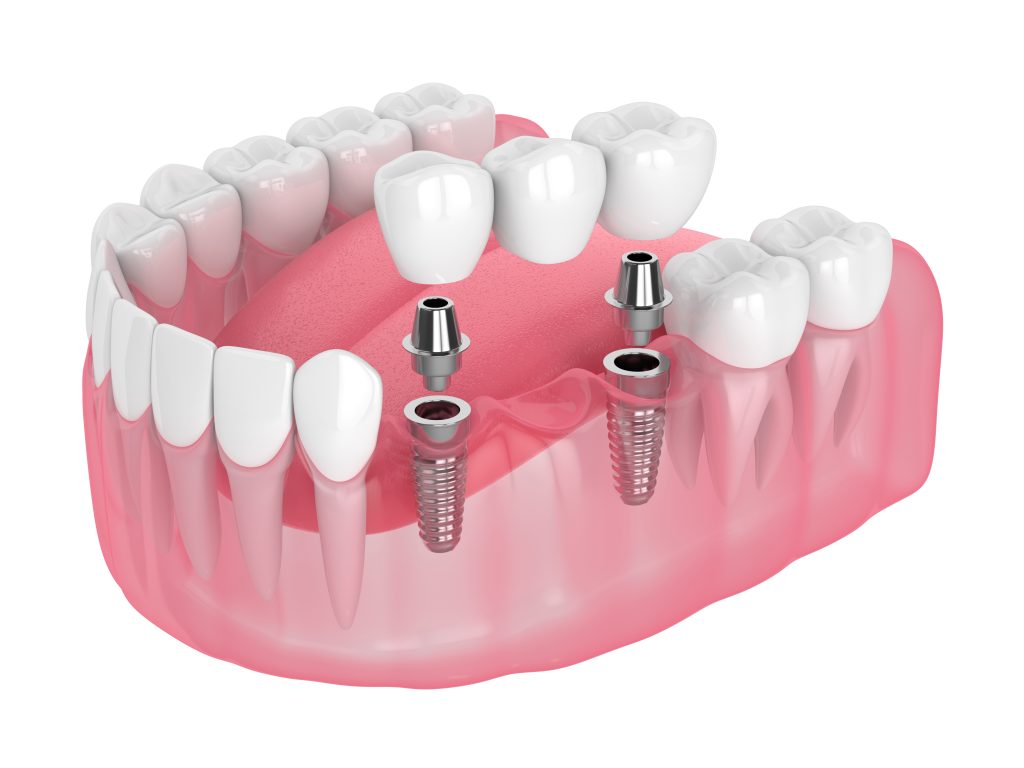 Multiple Teeth Missing
