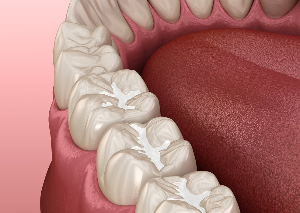 Dental Sealants