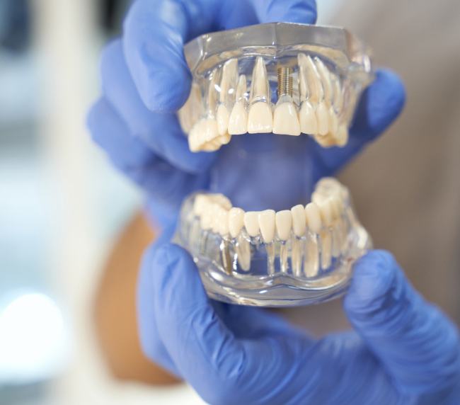 teeth-in-a-day
