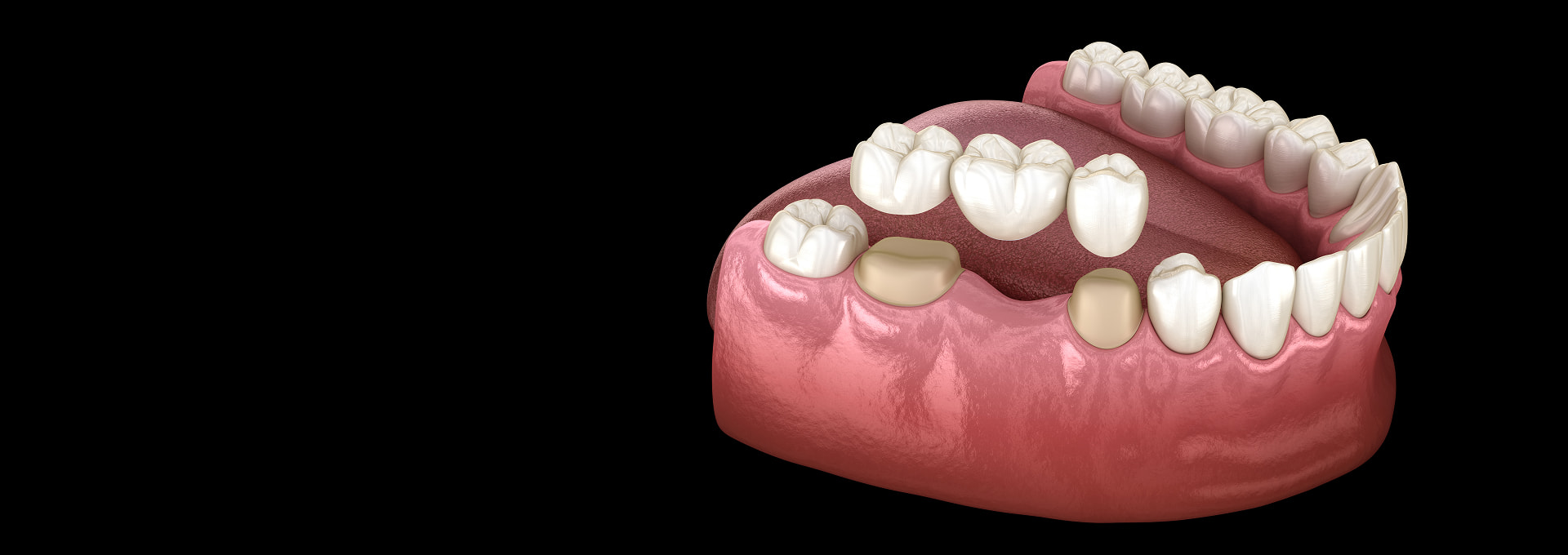Dental Crowns Banner Image