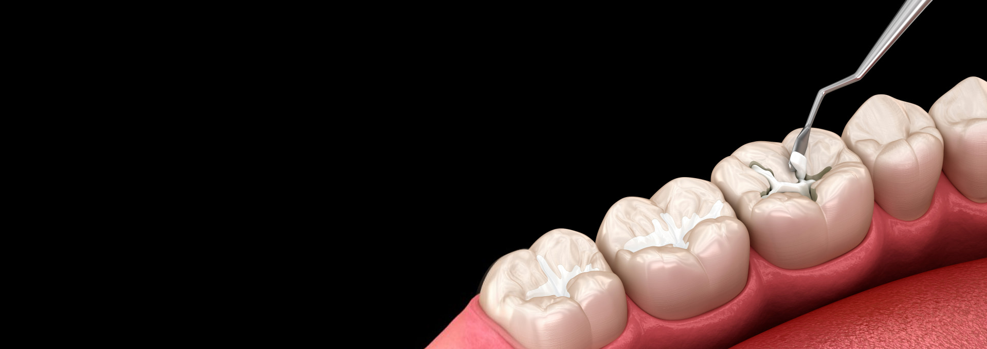 Dental Fillings Banner Image