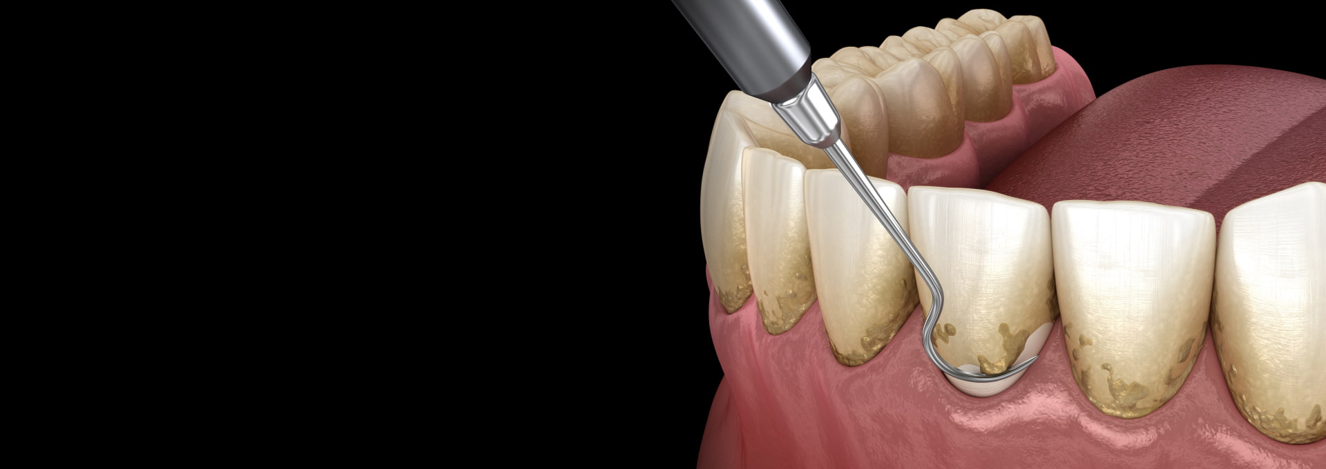 Periodontal Therapy Banner Image