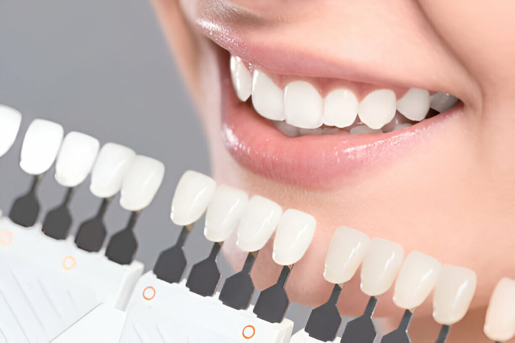 Raleigh Porcelain Veneers – Triangle Dentistry