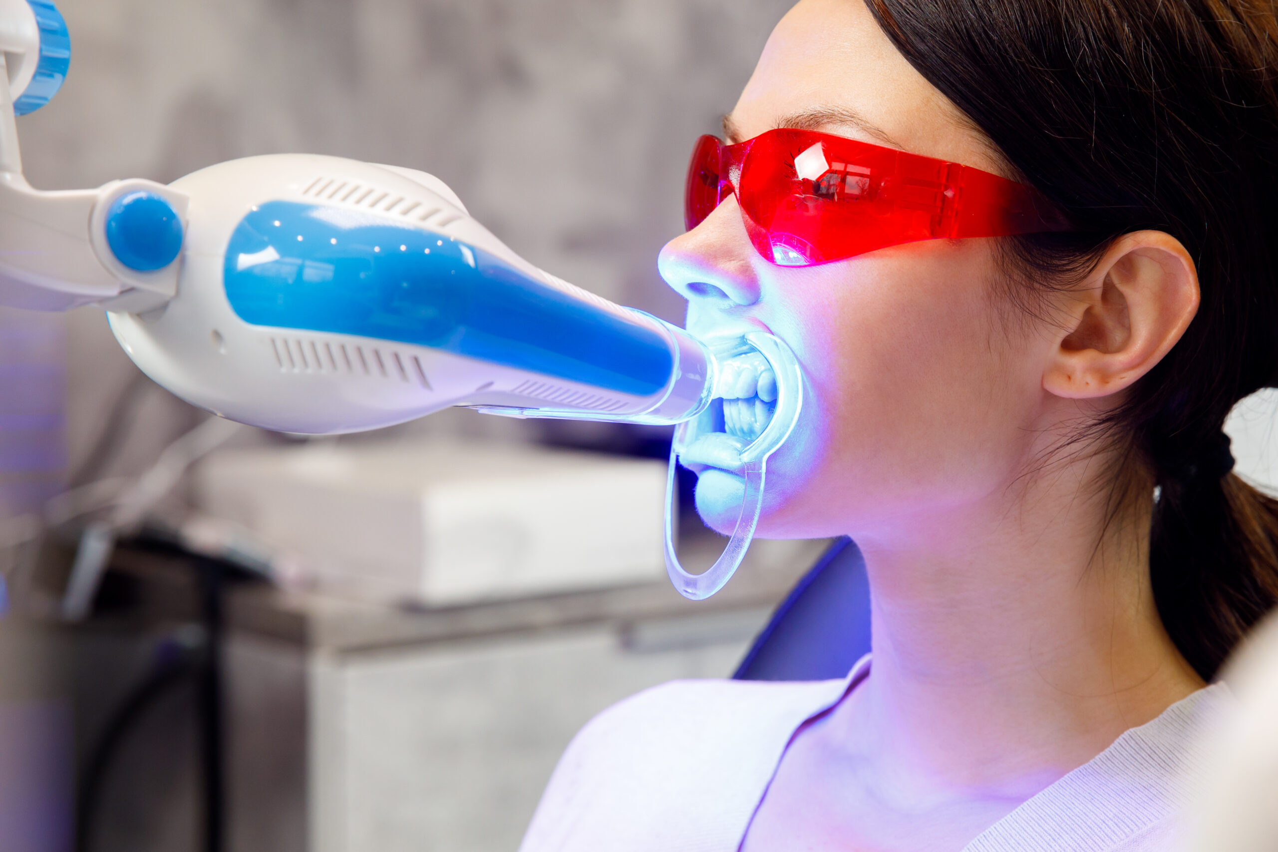 Professional teeth whitening in Raleigh NC